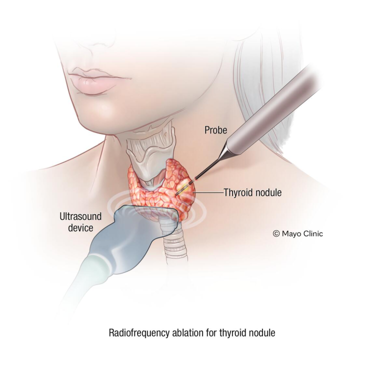 Mayo Clinic Minute Treating Thyroid Nodules Without Surgery Mayo