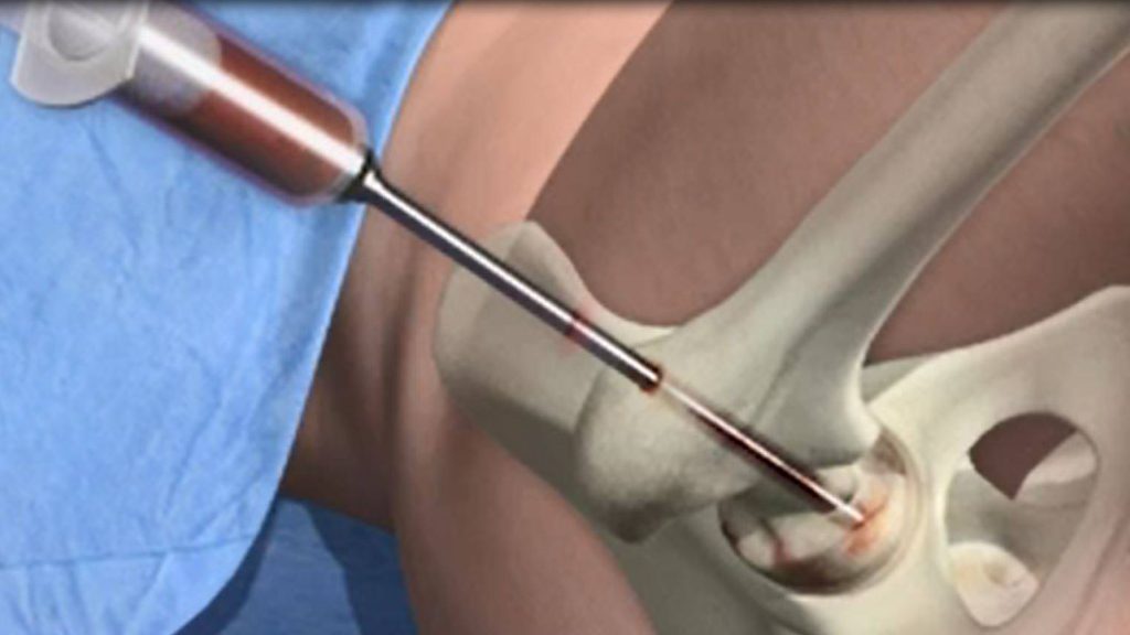 التقنية الجراحية في عملية إيثاق مفصل الورك