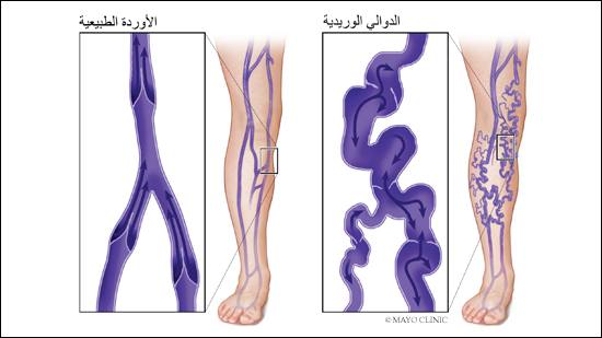 رسم توضيحي طبي لساق ذات أوردة طبيعية وأخرى بها دوالٍ وريدية