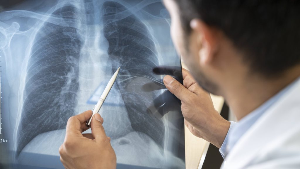 Médico apontando para um raio-x do pulmão com uma caneta