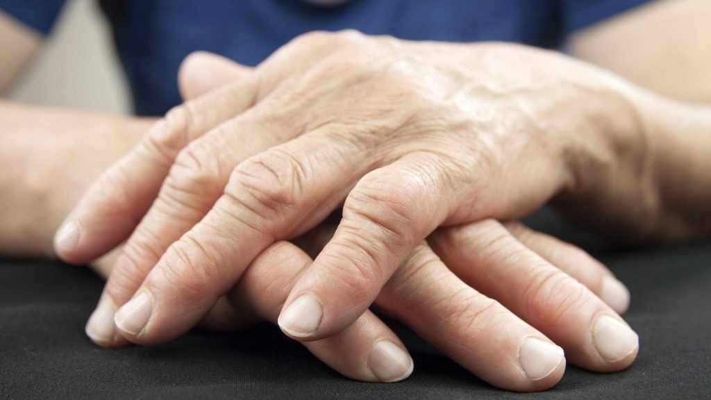 close-up de mãos com artrite reumatóide