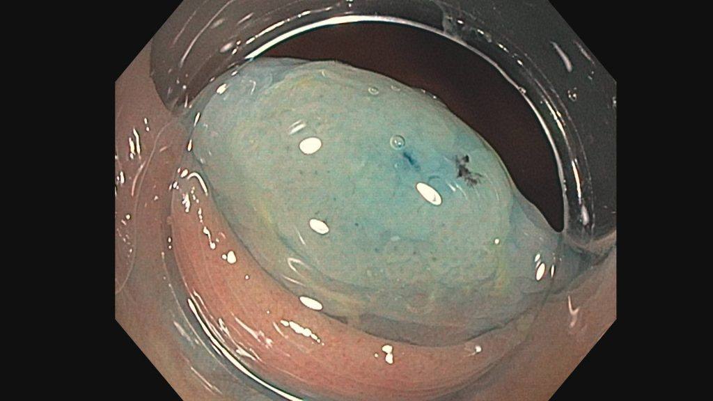 Um pólipo serrilhado após a injeção do corante azul para facilitar a identificação antes da remoção. Fonte: Mayo Clinic.