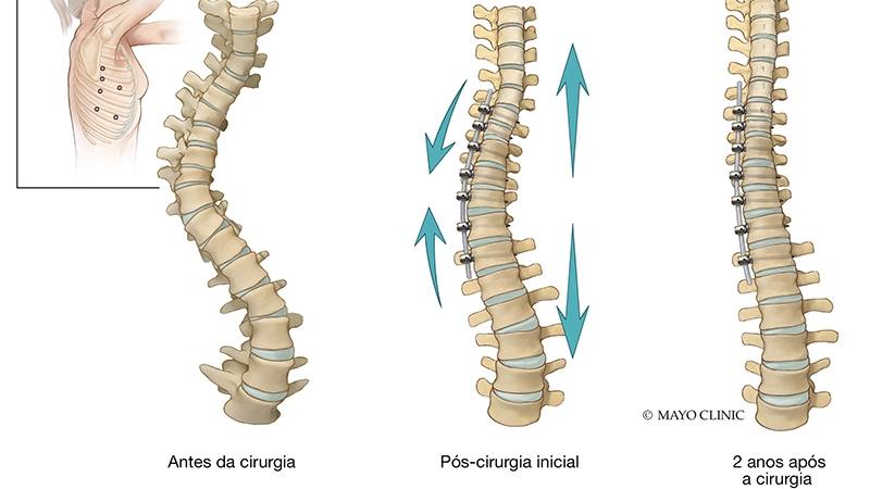  Amarração do corpo vertebral