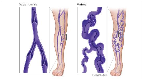 uma ilustração médica de uma perna com veias normais e uma com varizes