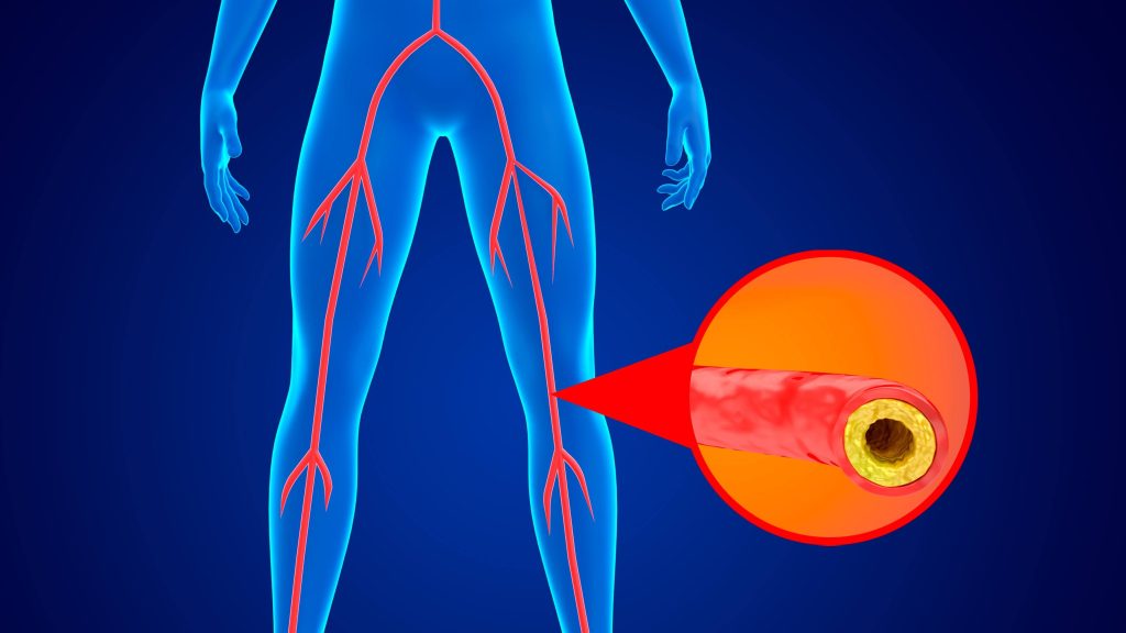 Ilustração médica da doença arterial periférica, acúmulo de gordura e cálcio nas paredes das artérias dos membros inferiores, impedindo o fluxo sanguíneo