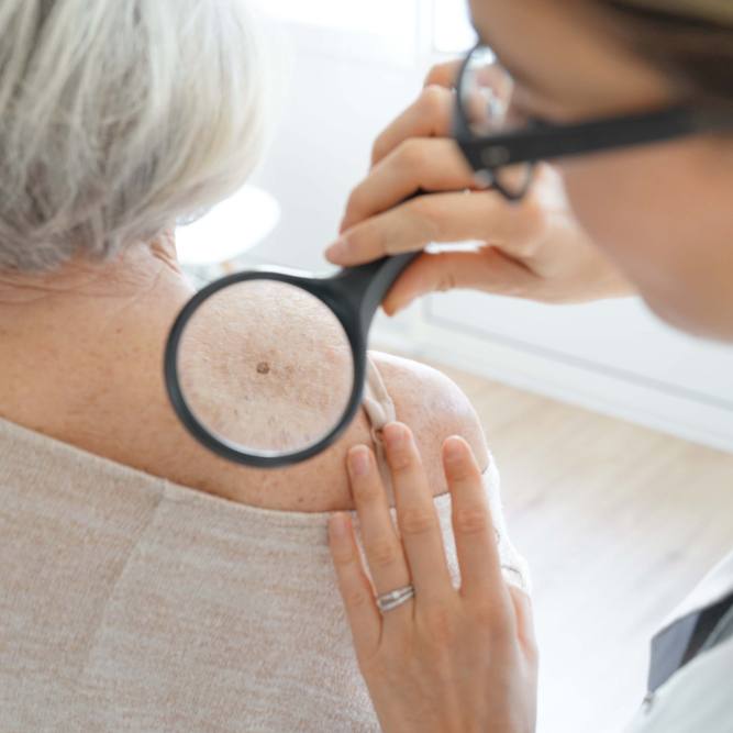 Novo teste genômico pode poupar algumas pessoas com melanoma da cirurgia de biópsia de linfonodo featured image