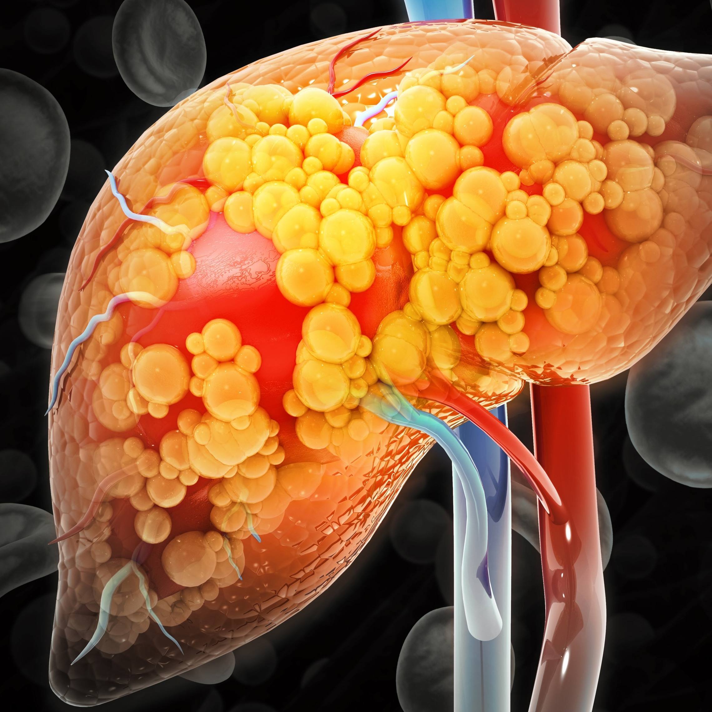 Novo estudo relaciona variação genética a danos hepáticos causados pela quimioterapia em pacientes com metástases hepáticas de câncer colorretal featured image