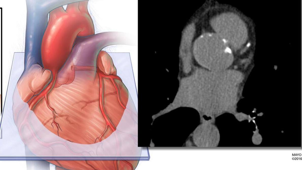 Inclusão de medida de gordura cardíaca derivada por IA melhora a precisão da predição de risco de doença cardiovascular featured image