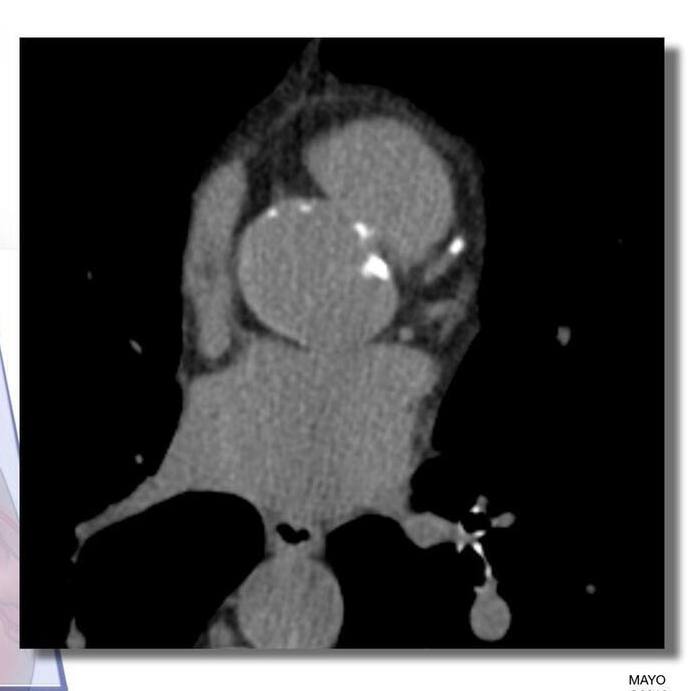 Inclusão de medida de gordura cardíaca derivada por IA melhora a precisão da predição de risco de doença cardiovascular featured image