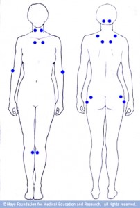 human body drawings with marks defining tender spots for fibromyalgia