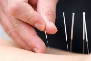 acupuncture needles being placed in the skin