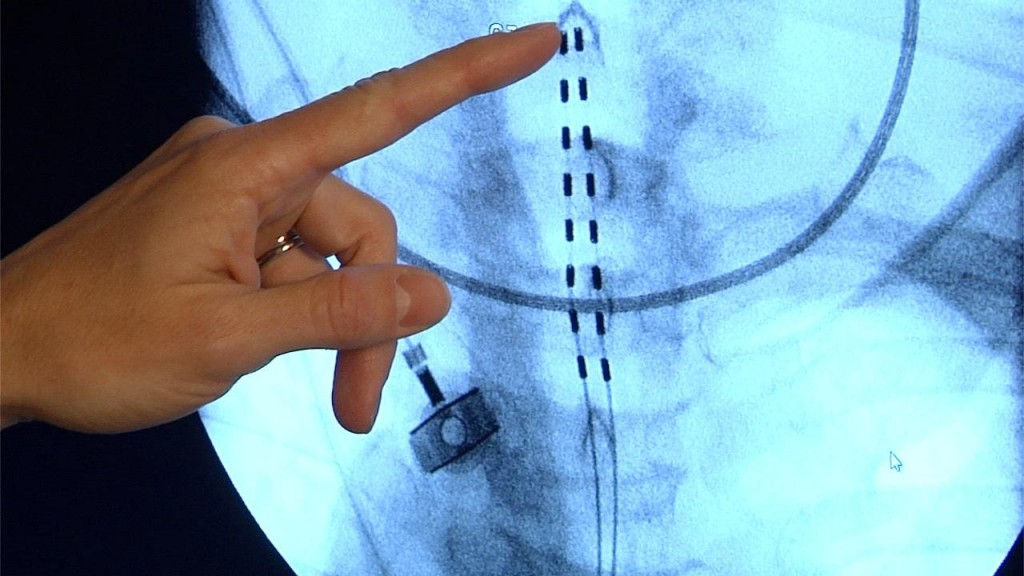 Light blue X-ray of spinal cord with the stimulator device inserted and technician hand pointing
