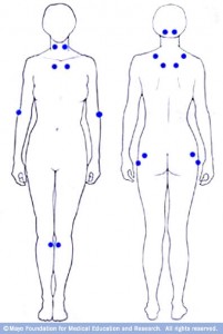 sketch of human body, front and back, with pain points of fibromyalgia