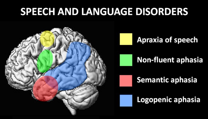 Graphic of the Brain with the titld "Speech and Language Disorders".