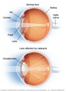 Mayo Clinic illustration of two eyeballs, one with a cataract and one without