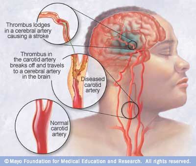 With stroke, time is survival - Mayo Clinic Health System