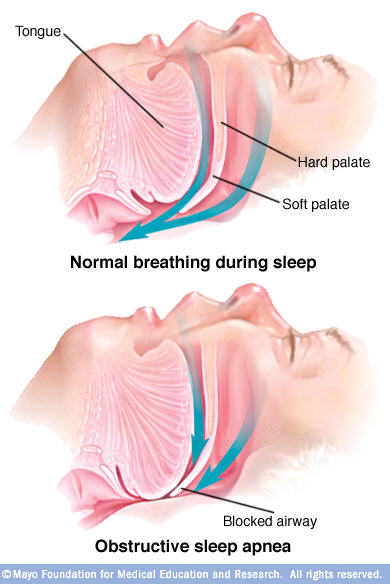 Illustrations of normal sleep breathing and blocked-airway sleep apnea breathing