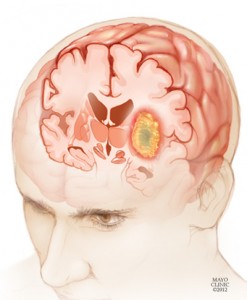 Illustration of a glioma in a young man