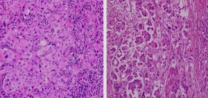 A typical low-grade bladder cancer (urothelial carcinoma), left, and micropapillary urothelial carcinoma (MPUC) appear side by side. Pathologists often have difficulty identifying MPUC, a more aggressive disease that has few good treatment options, says John Cheville, M.D., a Mayo Clinic pathologist. Genomic evaluations for amplification of the HER2 gene could help guide treatment decisions and improve care for a subset of these patients.