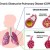 Ilustración de pulmones y bronquios con EPOC