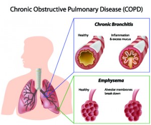 Ilustración de pulmones y bronquios con EPOC