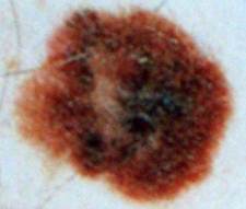 A suspicious mole showing melanoma skin cancer. 