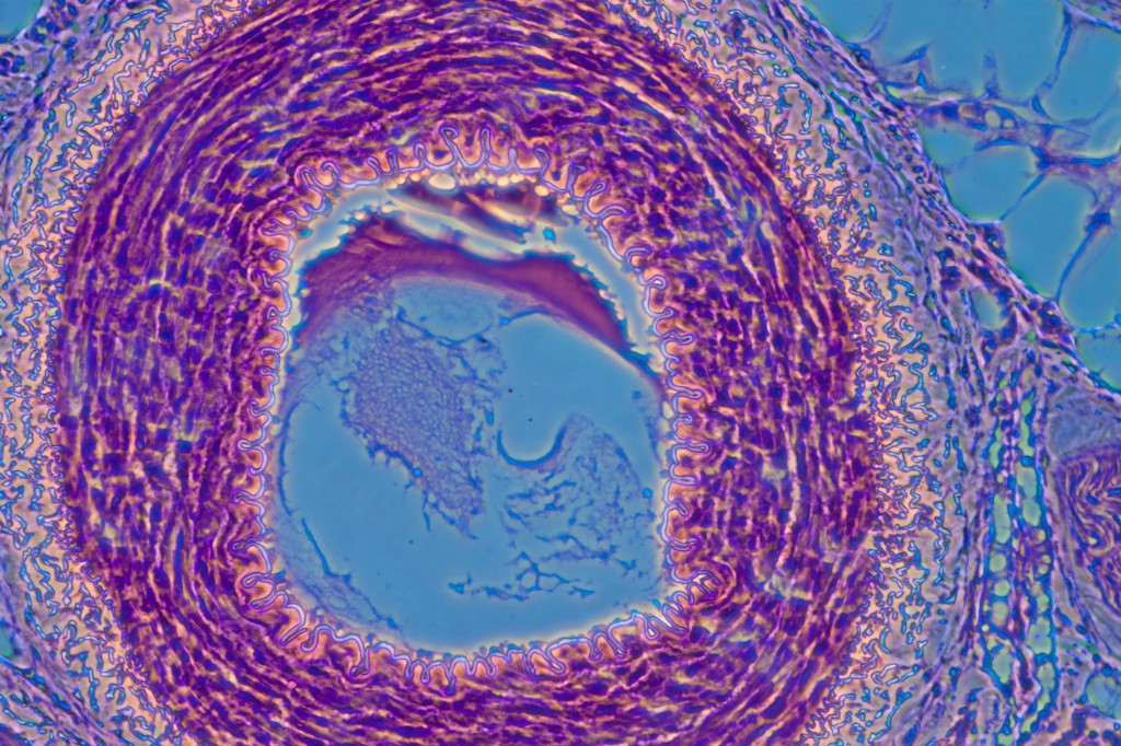 Micrograph of blood vessel, artery and vein - Vasculitis