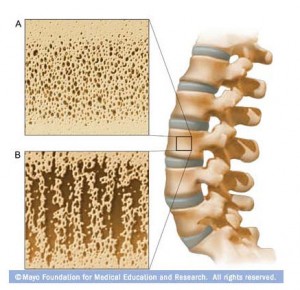 Mayo image of spine and bone density description