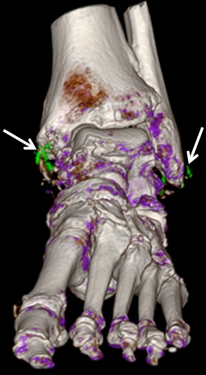 Gout1 CT Scan of uric acid crystals on foot skeleton