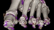 Frontal view of CT scan of foot with gout