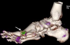 imagen de la tomografía computarizada de un pie que muestra los cristales de ácido úrico