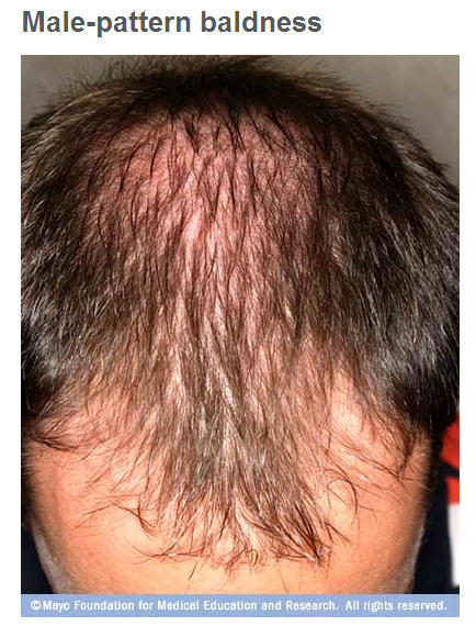 TUESDAY Q A Teen s Hair Loss Likely Result Of Genetics But 