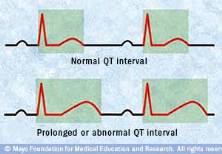 Ilustración de un ECG durante un intervalo QT normale y un intervalo QT prolongado