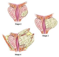 Ilustración del cáncer de próstata