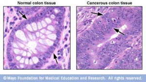 Microscopic image of colon tissue and colon cancer