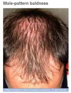 calvicie de patrón masculino y caída del cabello