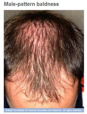 La caída del cabello en los posiblemente es genética, pero alternativas de tratamiento - Red de noticias de Clinic