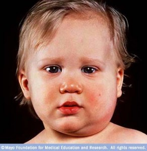 Young Toddler with Mumps