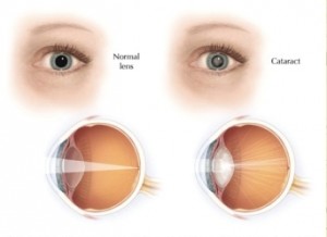 Ilustración de los ojos: normales y con cataratas