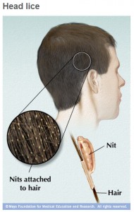 Mayo illustration of human hair with head lice