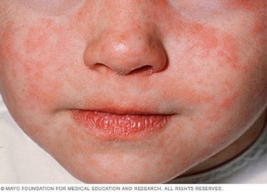Closeup of child face with measles