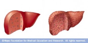Hígado normal (izquierda) e hígado con fibrosis