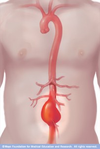 Graphic of abdominal aortic aneurysm