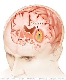 cáncer cerebral