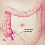 colon and inflamed appendix illustration