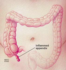 Colon and inflamed appendix illustration