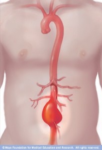 aneurisma aórtico abdominal