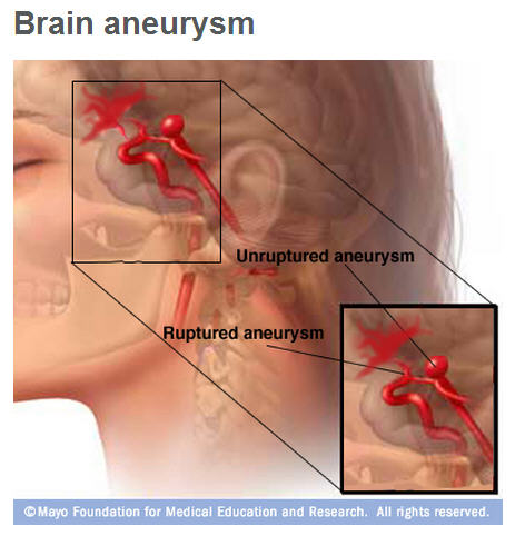 medical Illustration of unruptured and ruptured brain aneurysm