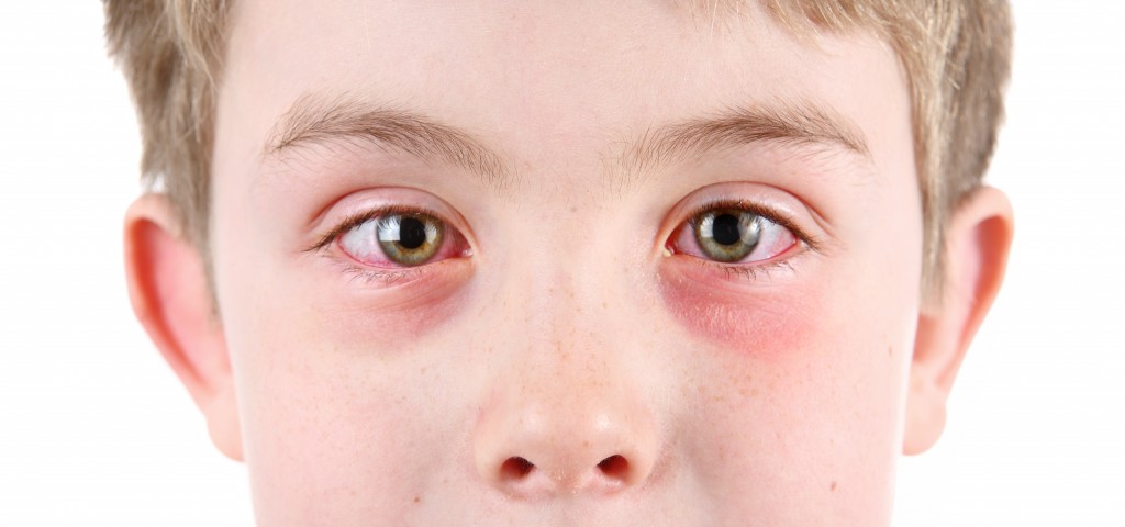 little boy with conjunctivitis or pink eye