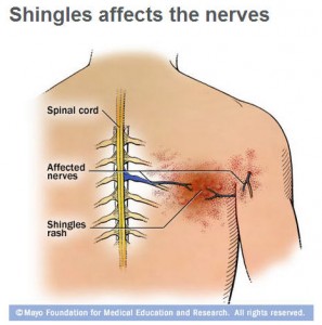 illustration of shingles affecting nerves in person's back